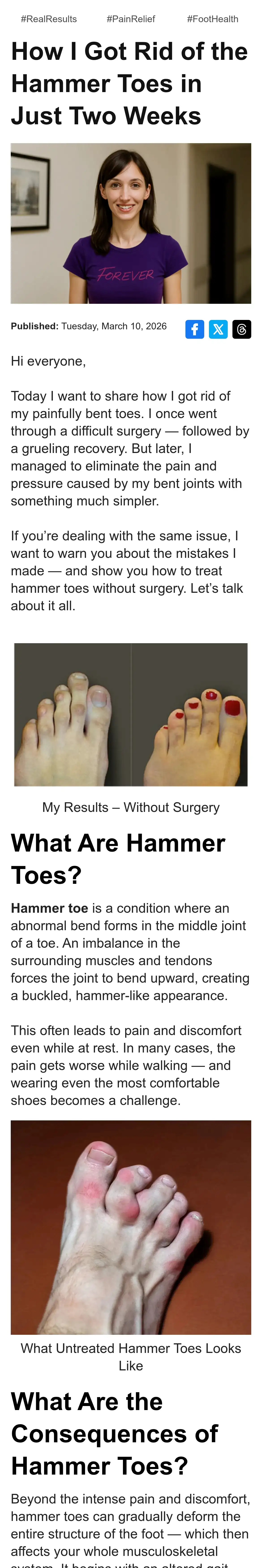 Hyggear: How I Got Rid of the Hammer Toes in Just Two Weeks