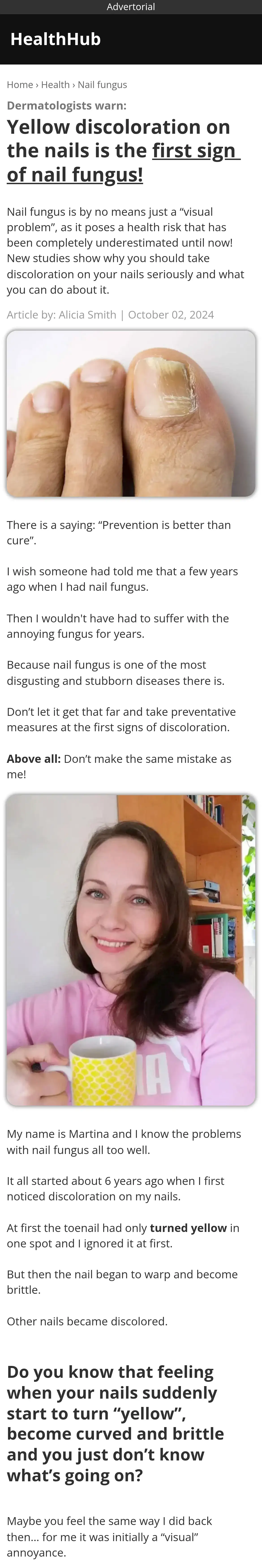 Alicia Smith: Dermatologists warn: Yellow discoloration on the nails is the first sign of nail fungus!